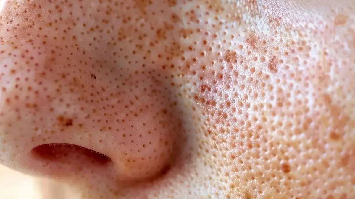Close-up of skin with small clustered holes, a harmless-looking image triggering trypophobia discomfort.