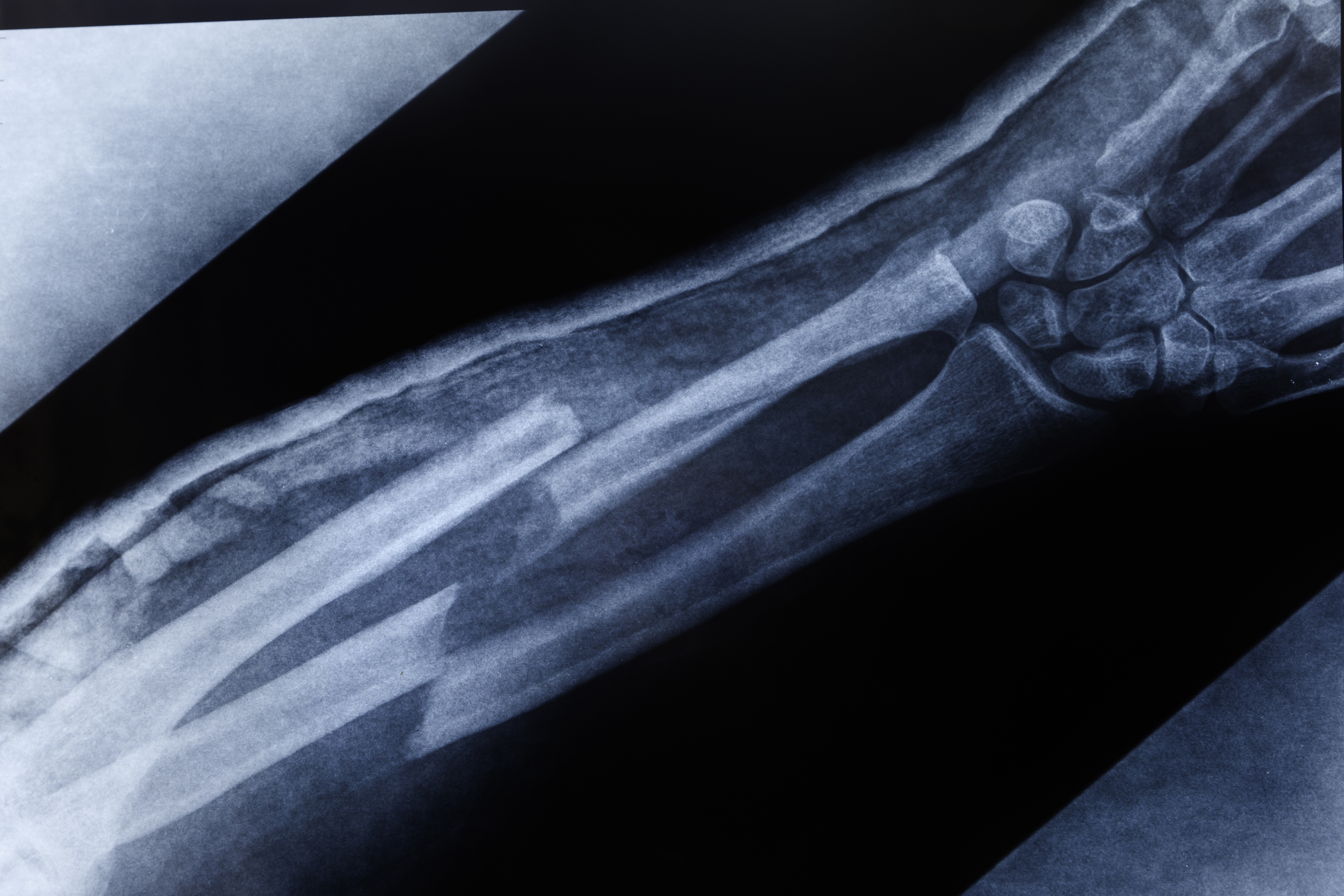 X-ray image showing a broken forearm bone, illustrating the broken bone theory discussed in the TikTok trend. X-ray image showing a broken forearm bone, illustrating the broken bone theory discussed in the TikTok trend.