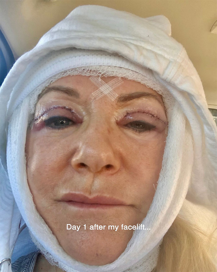 Close-up of a woman showing her aging progress one day after getting a facelift at 70 years old with visible stitches. Close-up of a woman showing her aging progress one day after getting a facelift at 70 years old with visible stitches.