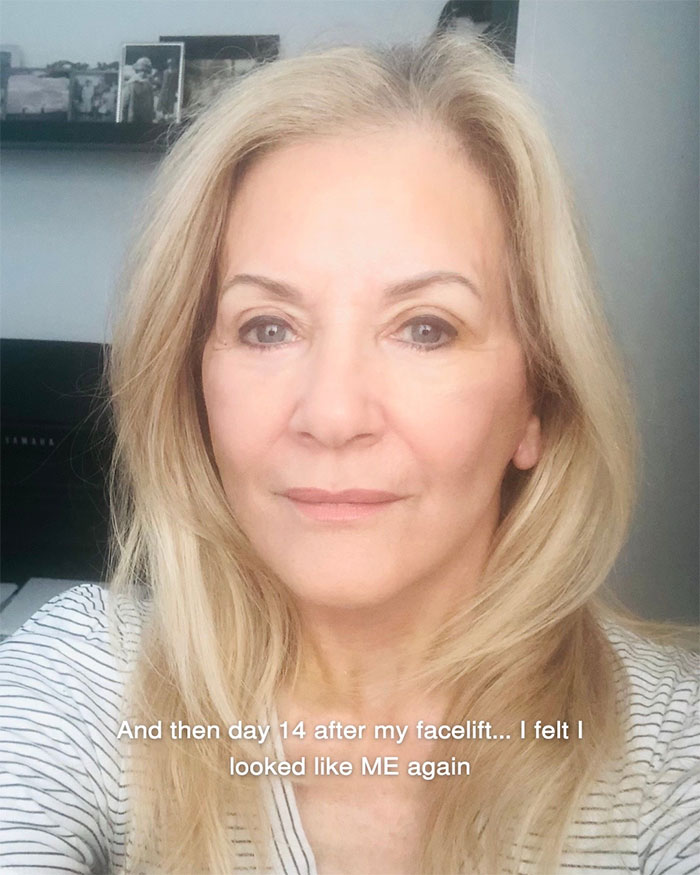 Woman showing aging progress and her appearance 14 days after facelift at 70 years old with natural look and long blonde hair. Woman showing aging progress and her appearance 14 days after facelift at 70 years old with natural look and long blonde hair.