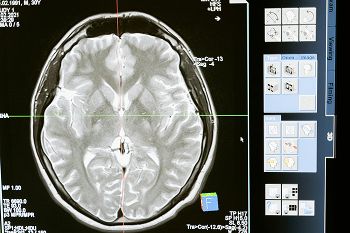 MRI scan of a human brain showing detailed structures in a study related to dogs and autism in humans. MRI scan of a human brain showing detailed structures in a study related to dogs and autism in humans.