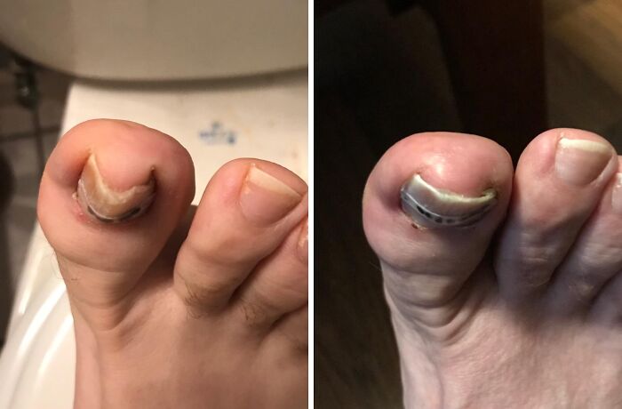  Declare A Ceasefire In The War Your Big Toe Is Waging Against Your Skin With This Ingrown Toenail Treatment Kit 