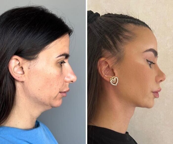 Side-by-side before and after images showing dramatic cosmetic surgery transformation in Turkey.