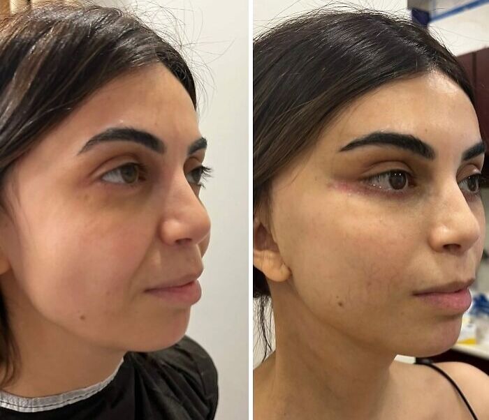 Side-by-side comparison of a woman before and after cosmetic surgery in Turkey showing facial transformation.