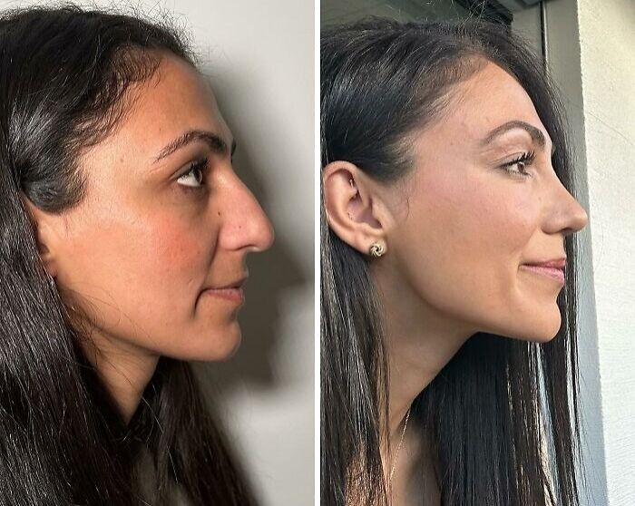 Side-by-side profile views of a woman before and after cosmetic surgery in Turkey showing dramatic transformation.