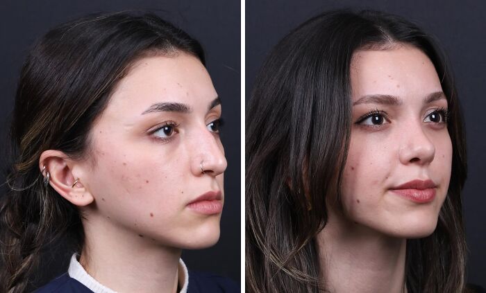 Side-by-side before and after photos of a woman showing cosmetic surgery results in Turkey, highlighting unrecognizable changes.