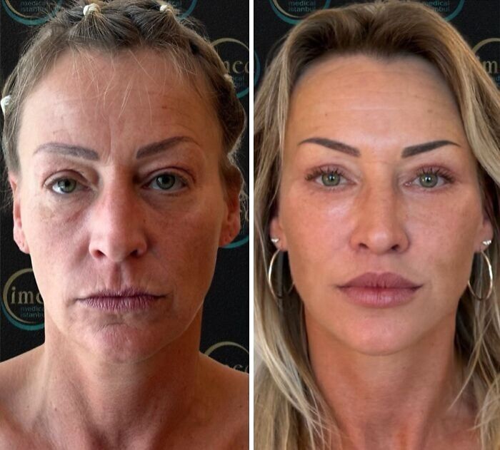 Before and after cosmetic surgery in Turkey showing dramatic facial transformation of a middle-aged woman. Before and after cosmetic surgery in Turkey showing dramatic facial transformation of a middle-aged woman.