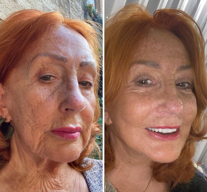 Before and after photos of a woman showing dramatic changes after cosmetic surgery in Turkey, highlighting transformation results.
