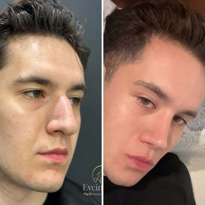 Side-by-side before and after images of a young man showing cosmetic surgery transformation in Turkey.