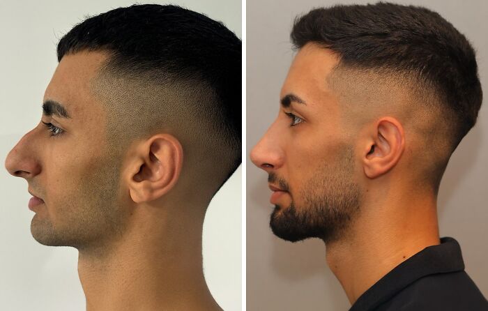 Side-by-side before and after profile images of a man who became unrecognizable after cosmetic surgery in Turkey.