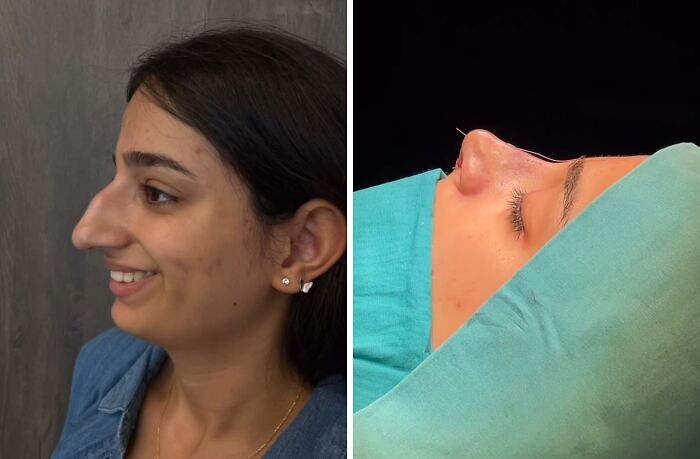 Side-by-side before and after photos showing cosmetic surgery results of a woman’s nose in Turkey.