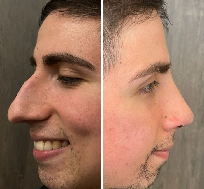 Before and after cosmetic surgery in Turkey showing a man’s transformed nose and facial profile.