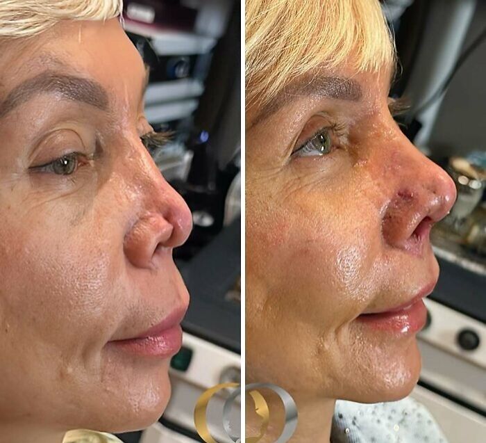 Side-by-side comparison of a woman before and after cosmetic surgery in Turkey showing facial changes and nose reshaping.