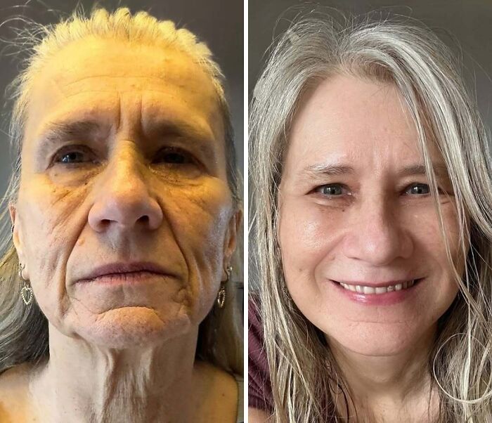 Before and after photos showing dramatic cosmetic surgery transformation in Turkey with significant facial rejuvenation results. Before and after photos showing dramatic cosmetic surgery transformation in Turkey with significant facial rejuvenation results.