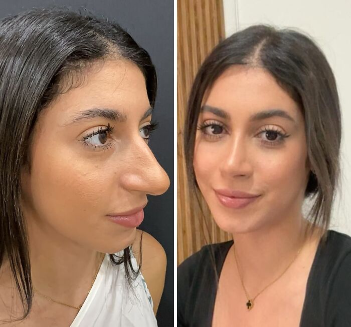 Side by side before and after photos showing a woman’s cosmetic surgery transformation in Turkey with a refined nose and softer features. Side by side before and after photos showing a woman’s cosmetic surgery transformation in Turkey with a refined nose and softer features.