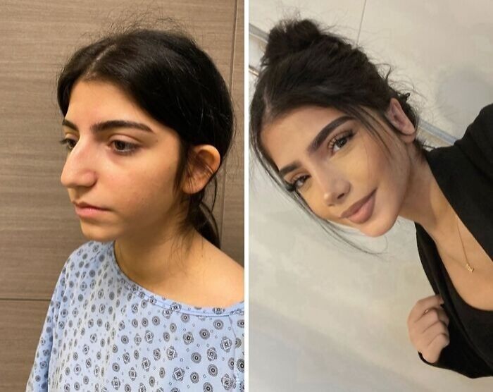 Before and after photos of a woman showing dramatic cosmetic surgery results in Turkey, highlighting unrecognizable transformation.