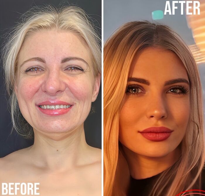 Before and after photos showing a woman’s dramatic cosmetic surgery transformation in Turkey, becoming unrecognizable.