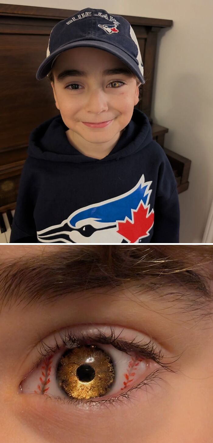 Young boy wearing Blue Jays cap and hoodie with close-up of golden brown eye showing red veins in detail spill now