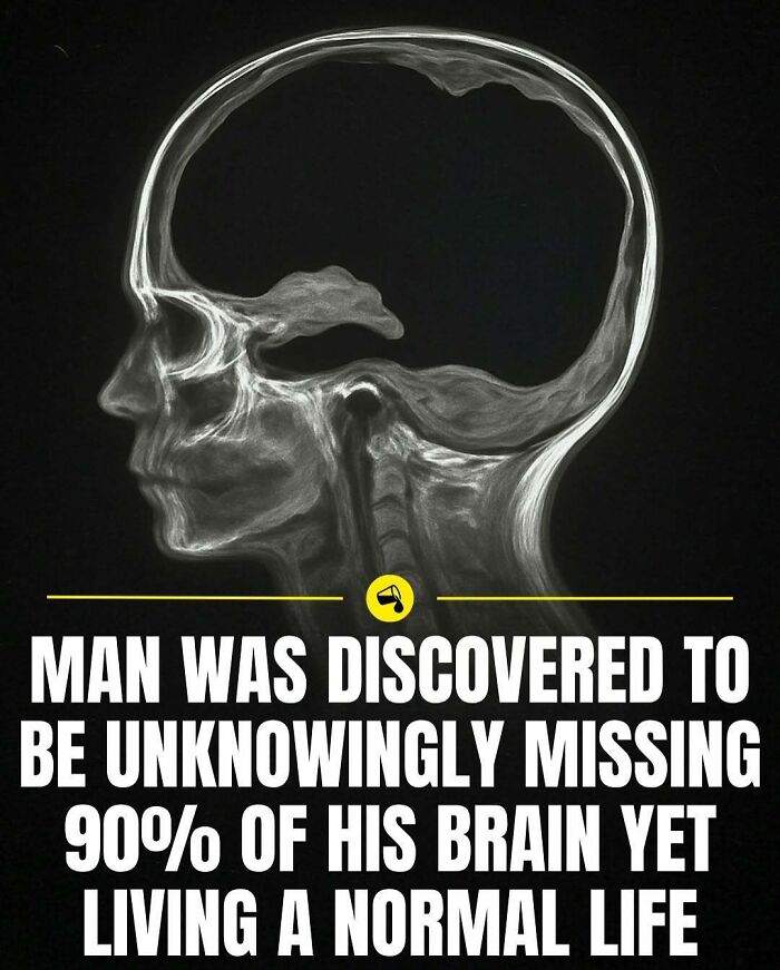 X-ray of a man missing 90 percent of his brain, highlighting surprising facts to see our world in a different light.