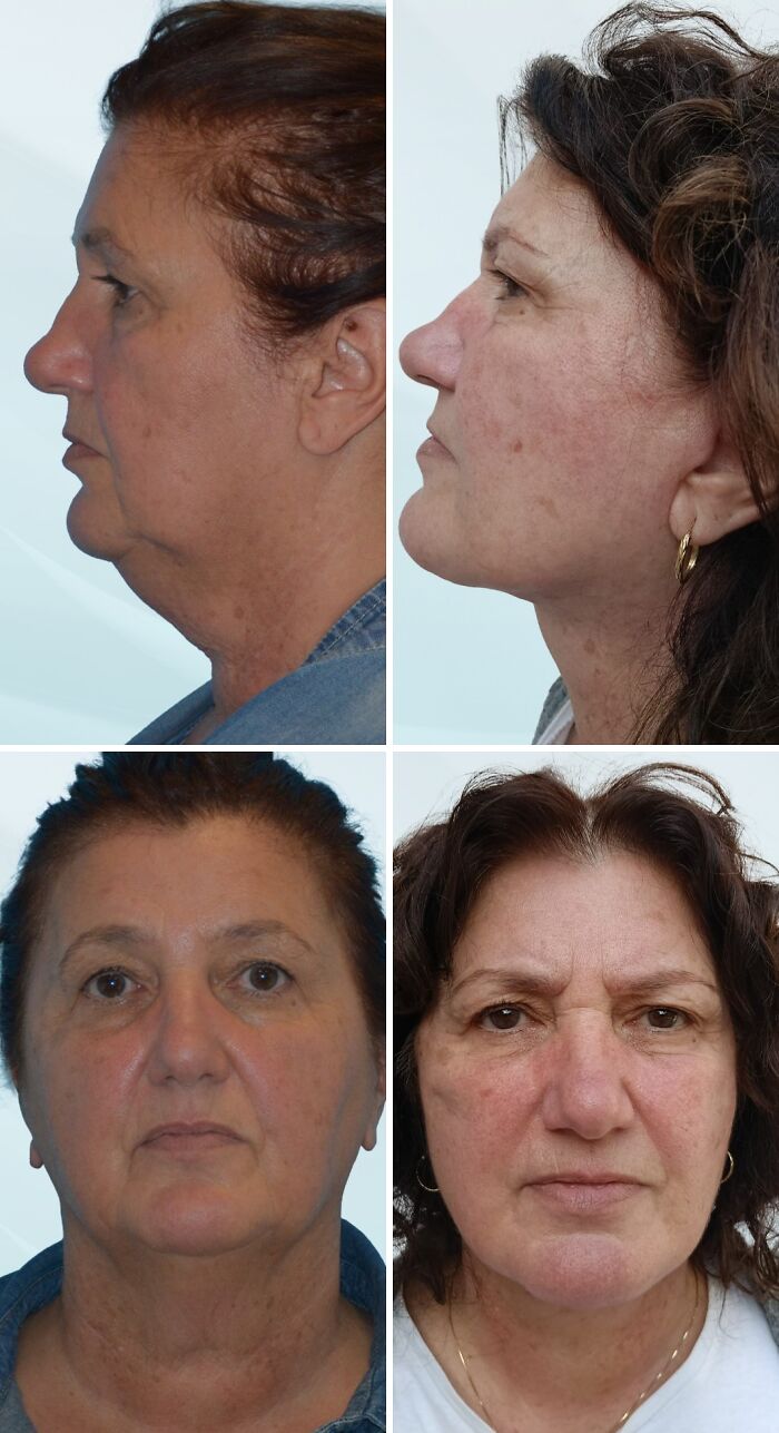 Before and after photos of a woman showing dramatic changes from cosmetic surgery in Turkey on her face and neck.