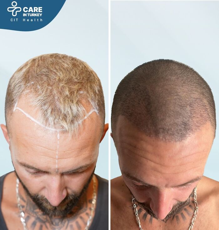 Before and after hair restoration treatment in Turkey, showing improved hair density and natural hairline results.