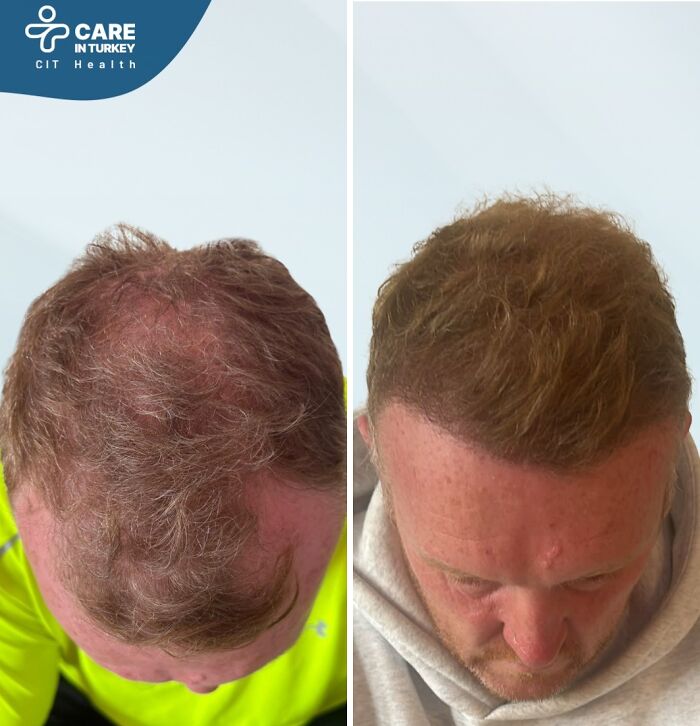 Before and after images showing hair restoration results from cosmetic surgery in Turkey on a man with thinning hair.