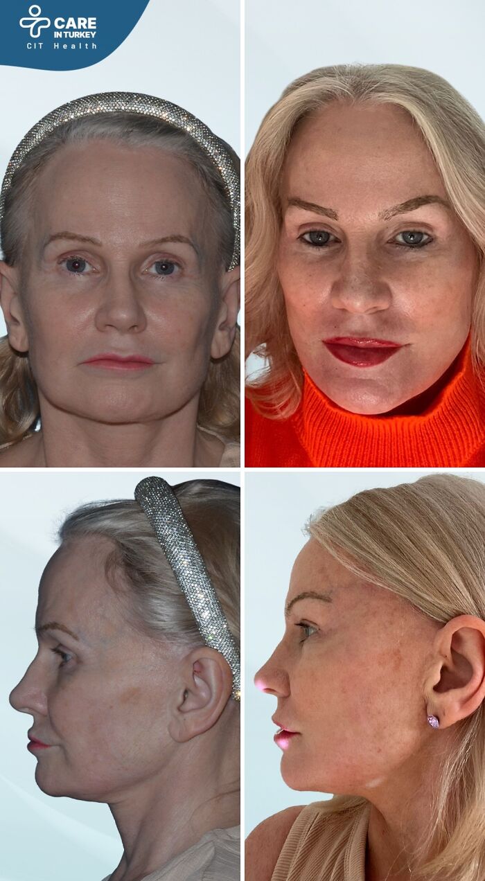 Before and after photos showing dramatic cosmetic surgery transformation in Turkey with noticeable facial enhancements.