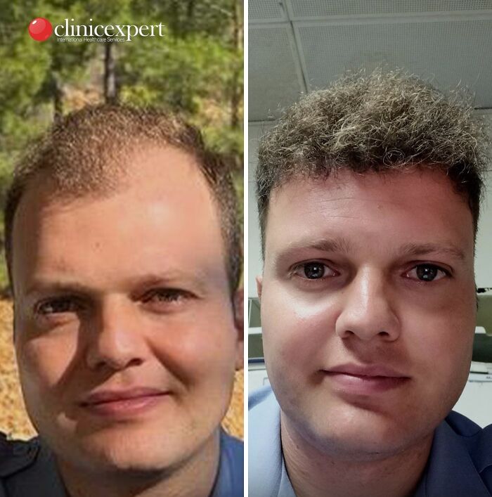 Before and after photos of a man showing cosmetic surgery results in Turkey with noticeable changes in hair and facial features.