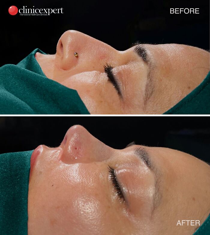 Side-by-side before and after photos showing cosmetic surgery results on a nose performed in Turkey.
