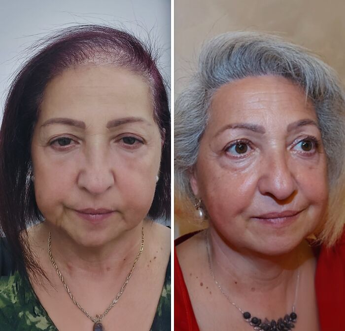 Before and after photos of a woman showing results of cosmetic surgery in Turkey with noticeable facial changes.