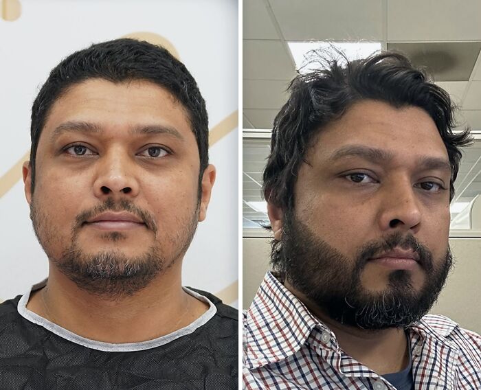 Before and after images showing drastic changes in appearance after cosmetic surgery in Turkey for a middle-aged man.