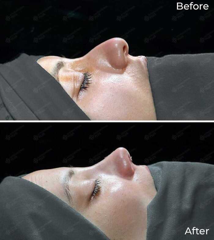 Side-by-side before and after profile of a woman showing cosmetic surgery results in Turkey.