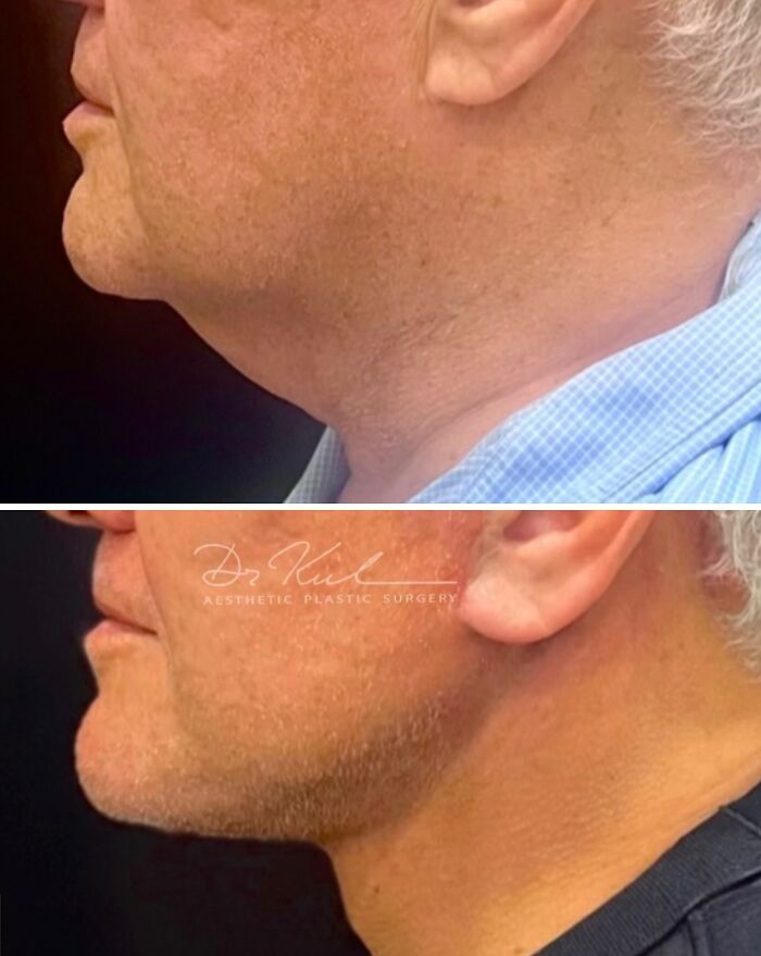 Side-by-side before and after photos showing cosmetic surgery results on the jawline and neck in Turkey.