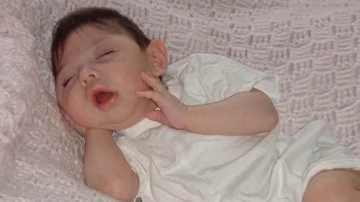 Baby girl born without most of her brain peacefully sleeping on a soft pink blanket, family shares their story. Baby girl born without most of her brain peacefully sleeping on a soft pink blanket, family shares their story.
