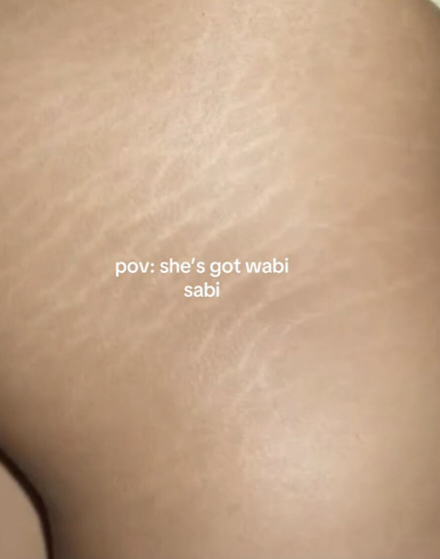 Close-up of skin showing stretch marks, representing perfect imperfections in a wholesome trend.