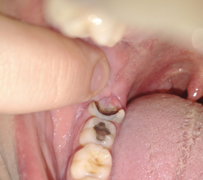Close-up of severe tooth decay inside a patient’s mouth revealing wildest patient horror stories dentists recall.