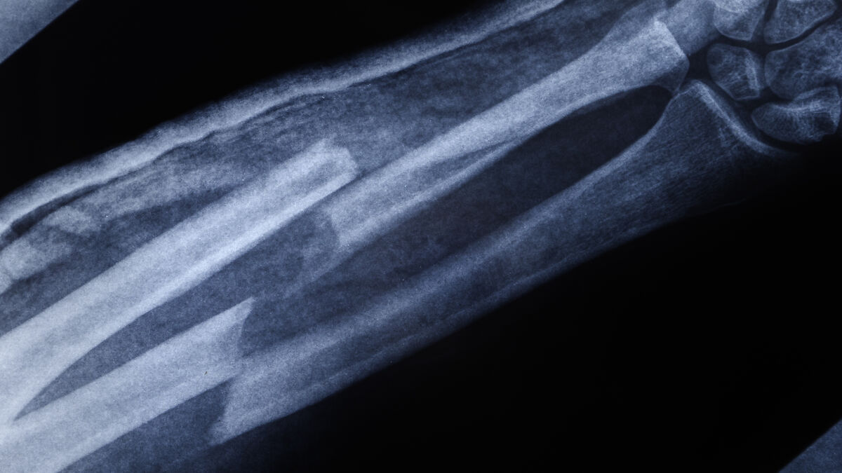X-ray image of a broken bone in the arm illustrating the broken bone theory in a medical context.