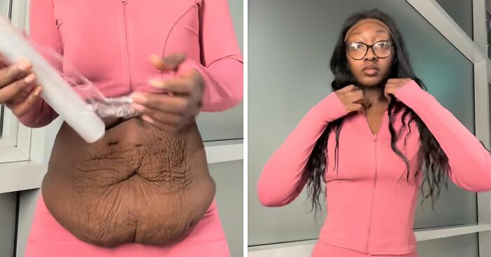 Woman’s Trick To Hide Loose Skin On Her Belly After Massive Weight Loss Stuns People