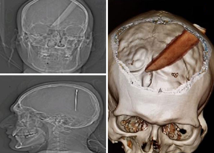 X-ray and 3D scan images showing unusual objects lodged in the skull from bizarre ER stories and medical emergencies.