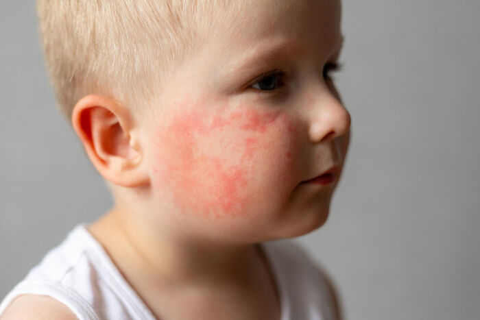 Young child with a red rash on their cheek illustrating the common confusion between Dr. Google and real doctor advice.