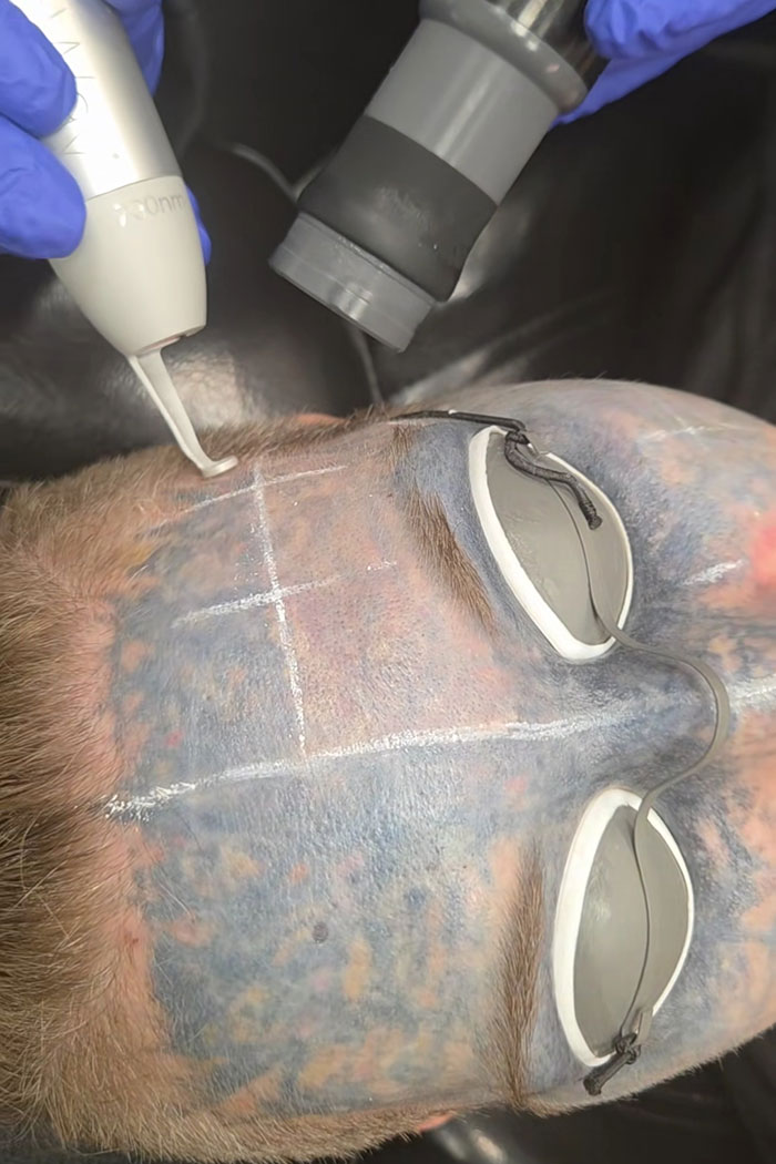 Close-up of a prominent face tattoo being treated with a laser by a person wearing blue gloves.