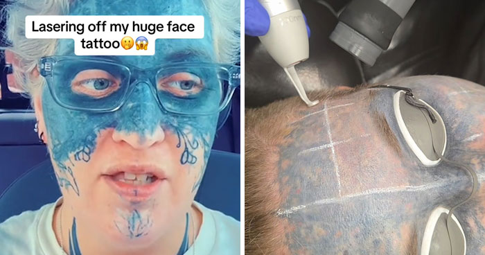 Brave Woman Shares Story Of Removing Unwanted Face Tattoo After Cruel Prank