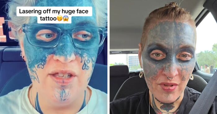 Brave Woman Shares Story Of Removing Unwanted Face Tattoo After Cruel Prank