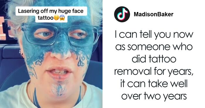 Brave Woman Shares Story Of Removing Unwanted Face Tattoo After Cruel Prank