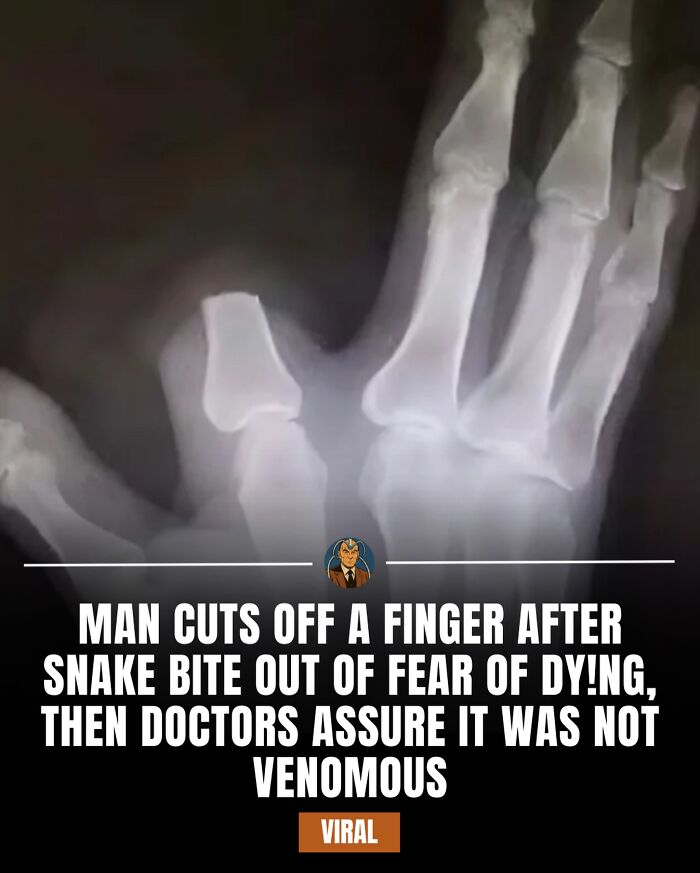 X-ray image of a finger with text about an IG page sharing daily facts and interesting stories going viral.