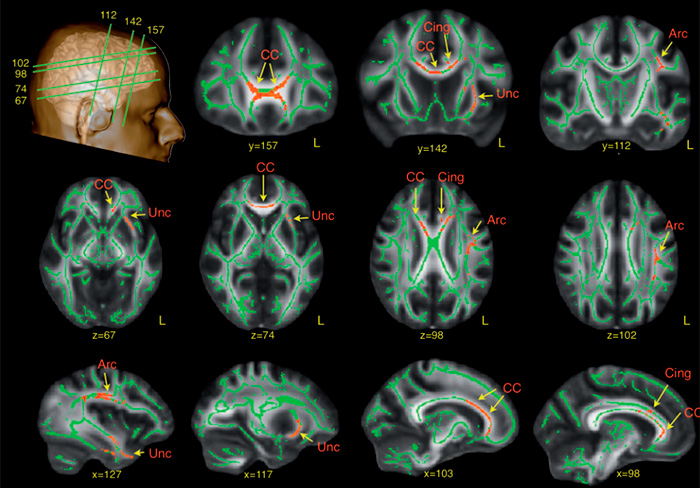 Brain scan images highlighting corpus callosum and cingulate regions in research on whether dogs can be autistic like humans. Brain scan images highlighting corpus callosum and cingulate regions in research on whether dogs can be autistic like humans.