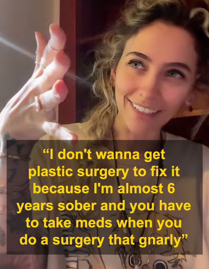 Smiling woman with curly hair shares experience of how substance use deformed her face and affects plastic surgery choices. Smiling woman with curly hair shares experience of how substance use deformed her face and affects plastic surgery choices.