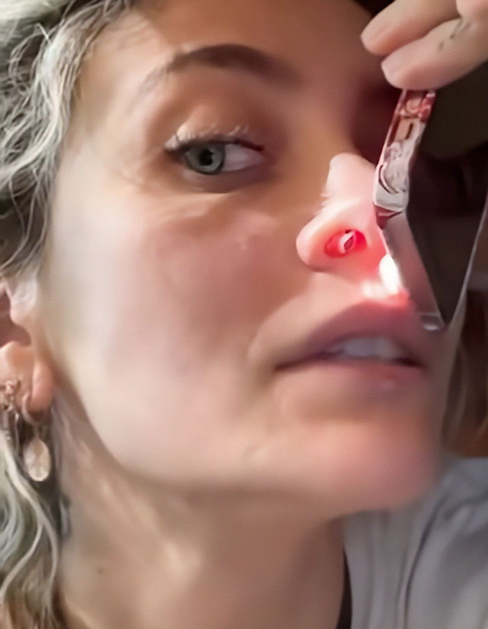 Close-up of a woman undergoing a medical facial examination showing signs of substance use deforming her face and nose. Close-up of a woman undergoing a medical facial examination showing signs of substance use deforming her face and nose.