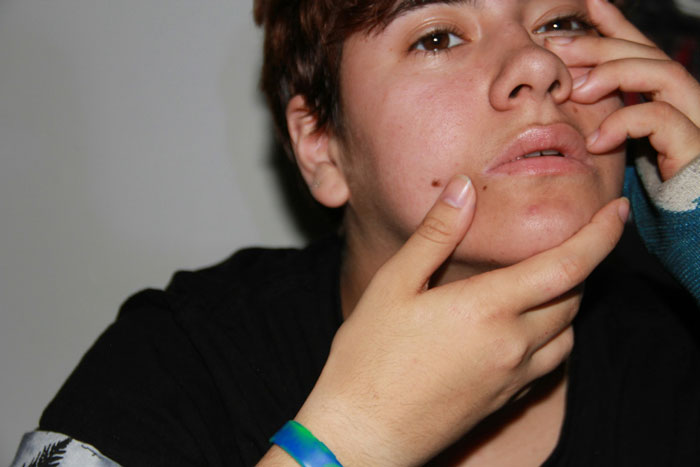 Young boy showing a mole on his face, highlighting concerns about cosmetic surgery and mole removal approval. Young boy showing a mole on his face, highlighting concerns about cosmetic surgery and mole removal approval.