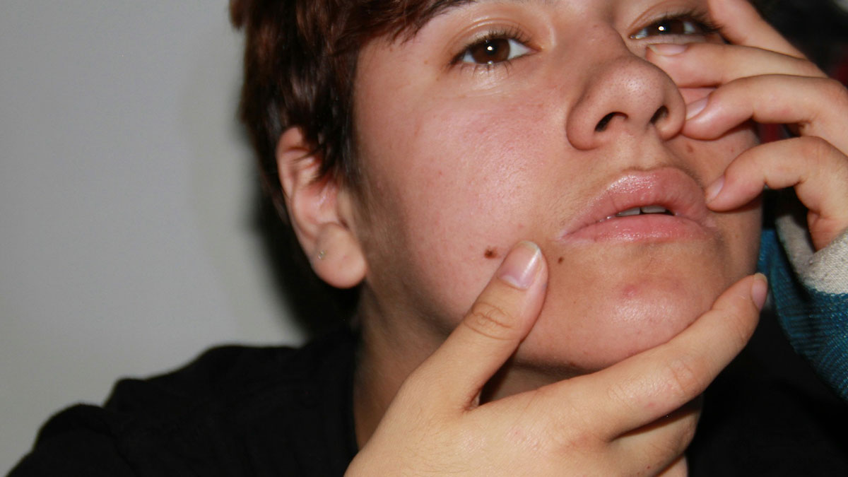 Close-up of a young boyu2019s face showing a noticeable mole before cosmetic surgery removal approved by dad.